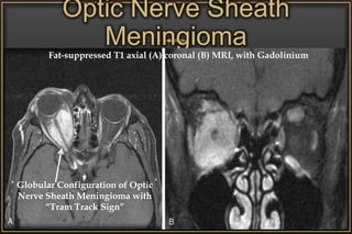 Optic Nerve Sheath
Meningioma
Globular Configuration of Optic
Nerve Sheath Meningioma with
“Tram Track Sign”
Fat-suppressed T1 axial (A) coronal (B) MRI, with Gadolinium
 