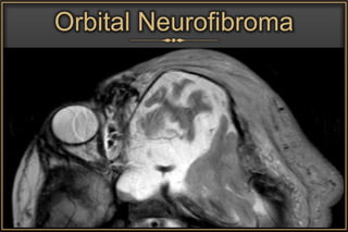 Orbital Neurofibroma
 