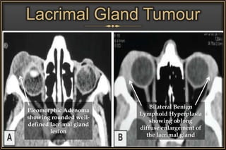 Lacrimal Gland Tumour
Pleomorphic Adenoma
showing rounded well-
defined lacrimal gland
lesion
Bilateral Benign
Lymphoid Hyperplasia
showing oblong
diffuse enlargement of
the lacrimal gland
 