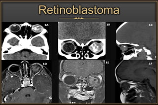 Retinoblastoma
 