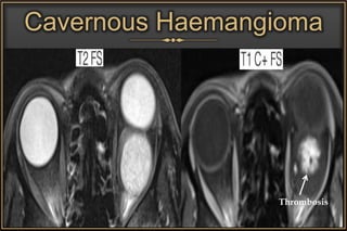 Cavernous Haemangioma
Thrombosis
 