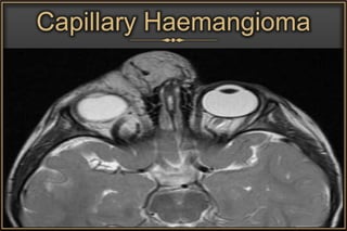 Capillary Haemangioma
 