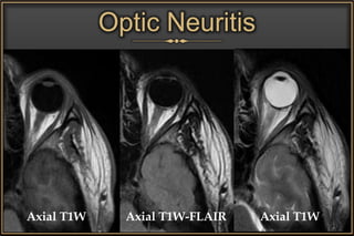 Optic Neuritis
Axial T1W Axial T1W-FLAIR Axial T1W
 