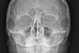 Radiography
Plain X-Ray of the Orbit
• Very limited role
• Indications:
 Traumatic Injuries
 Foreign Bodies
 