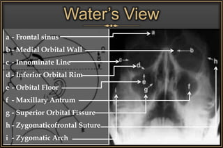 Water’s View
a - Frontal sinus
b - Medial Orbital Wall
c - Innominate Line
d - Inferior Orbital Rim
e - Orbital Floor
f - Maxillary Antrum
g - Superior Orbital Fissure
h - Zygomaticofrontal Suture
i - Zygomatic Arch
 