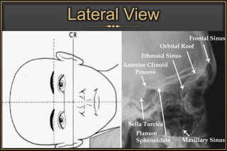 Lateral View
Orbital Roof
Ethmoid Sinus
Anterior Clinoid
Process
Sella Turcica
Planum
Sphenoidale
Frontal Sinus
Maxillary Sinus
 