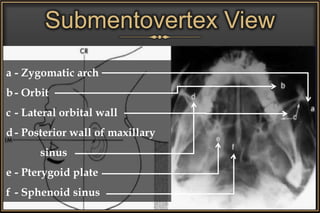 Submentovertex View
a - Zygomatic arch
b - Orbit
c - Lateral orbital wall
d - Posterior wall of maxillary
sinus
e - Pterygoid plate
f - Sphenoid sinus
 