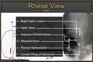 Rhese View
a - Right Optic Canal
b - Optic Strut
c - Superior Orbital Fissure
d - Ethmoid Sinus
e - Planum Sphenoidale
f - Greater Wing of Sphenoid
 