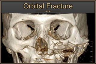 Orbital Fat
Herniation
Orbital
Emphysema
Orbital Fracture
Water’s View
 
