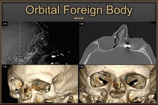 Orbital Foreign Body
 