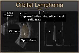 Cornea
Orbital Lymphoma
Lens Retina
Vitreous
Optic Nerve
Hyper-reflective retrobulbar round
solid mass
 