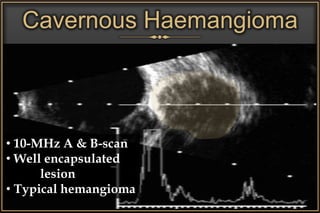 Cavernous Haemangioma
• 10-MHz A & B-scan
• Well encapsulated
lesion
• Typical hemangioma
 