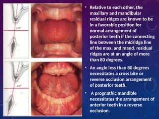 Inverted Ridge RESIDUAL RIDGE RESORPTION in complete denture | PPTX