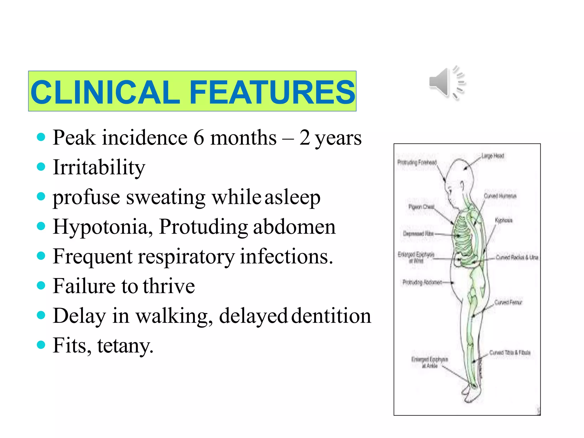 CLINICAL FEATURES
 Peak incidence 6 months – 2 years
 Irritability
 profuse sweating whileasleep
 Hypotonia, Protuding abdomen
 Frequent respiratory infections.
 Failure to thrive
 Delay in walking, delayeddentition
 Fits, tetany.
 