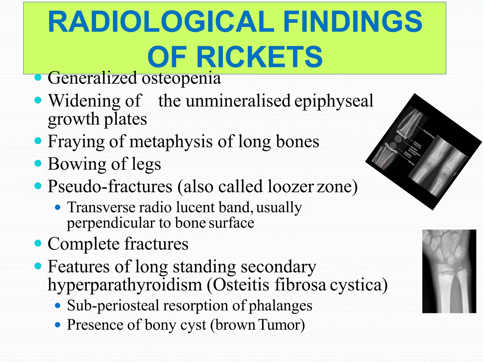 RADIOLOGICAL FINDINGS
OF RICKETS
 Generalized osteopenia
 Widening of the unmineralised epiphyseal
growth plates
 Fraying of metaphysis of long bones
 Bowing of legs
 Pseudo-fractures (also called loozerzone)
 Transverse radio lucent band,usually
perpendicular to bonesurface
 Complete fractures
 Features of long standing secondary
hyperparathyroidism (Osteitis fibrosa cystica)
 Sub-periosteal resorption of phalanges
 Presence of bony cyst (brownTumor)
 