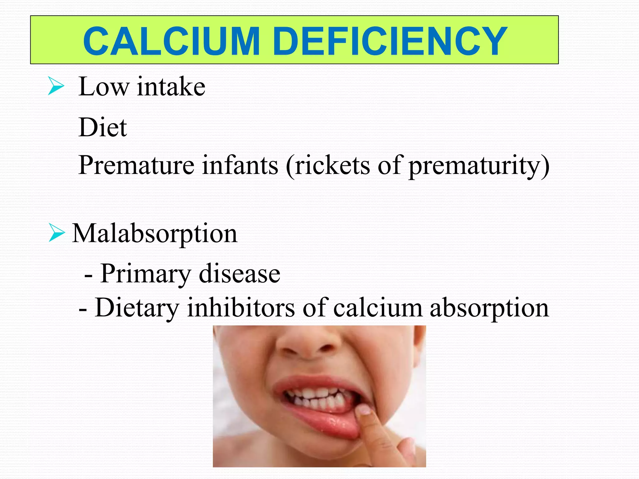 CALCIUM DEFICIENCY
 Low intake
Diet
Premature infants (rickets of prematurity)
 Malabsorption
- Primary disease
- Dietary inhibitors of calcium absorption
 