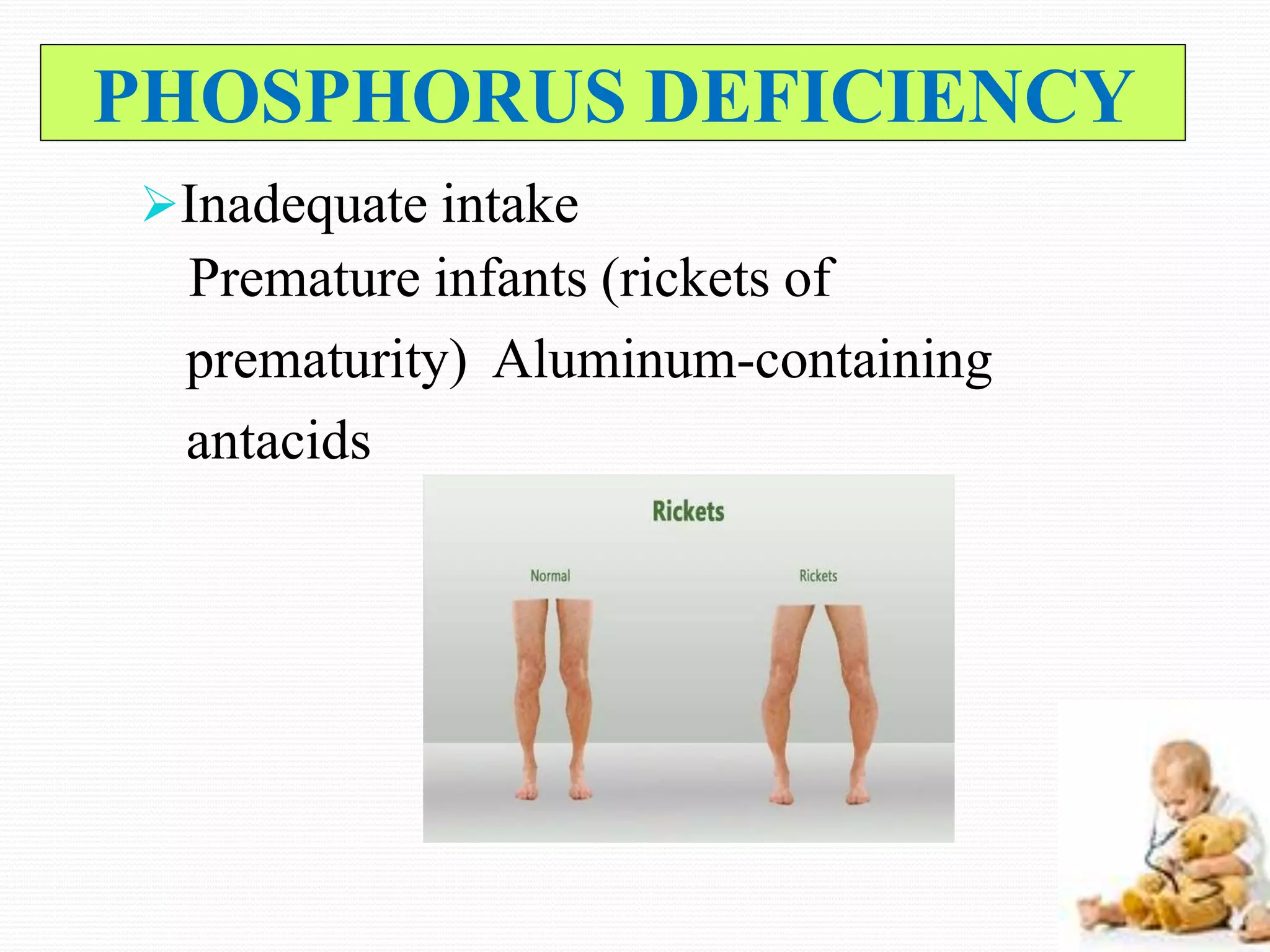 PHOSPHORUS DEFICIENCY
Inadequate intake
Premature infants (rickets of
prematurity) Aluminum-containing
antacids
 