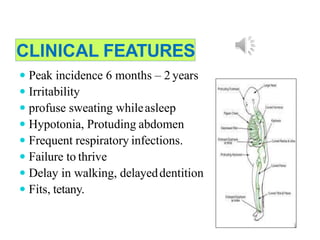 CLINICAL FEATURES
 Peak incidence 6 months – 2 years
 Irritability
 profuse sweating whileasleep
 Hypotonia, Protuding abdomen
 Frequent respiratory infections.
 Failure to thrive
 Delay in walking, delayeddentition
 Fits, tetany.
 