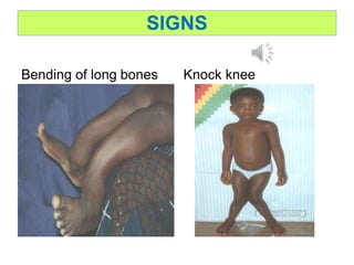 SIGNS
Bending of long bones Knock knee
 