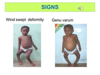 SIGNS
Wind swept deformity Genu varum
 