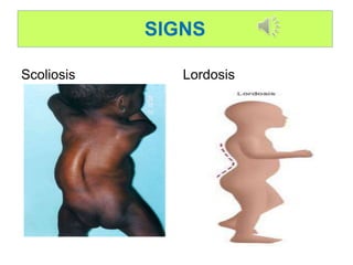 SIGNS
Scoliosis Lordosis
 