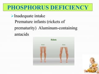 PHOSPHORUS DEFICIENCY
Inadequate intake
Premature infants (rickets of
prematurity) Aluminum-containing
antacids
 