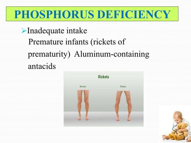 RICKETS IN CHILDREN | PPTX | Bone and Joint Conditions | Diseases and ...