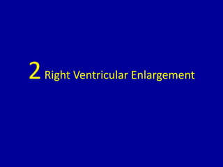 2Right Ventricular Enlargement
 