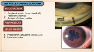 1. Peripheral Anterior Synechiae (PAS)
2. Posterior Synechiae
3. Seclusio, Occlusio pupillae
1. Phacomorphic glaucoma (intumescent)
2. Lens subluxation
 