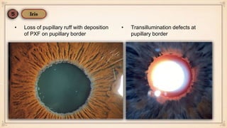 Pupillary Ruff Loss 2ry OAG, OHT, NTG | PPTX