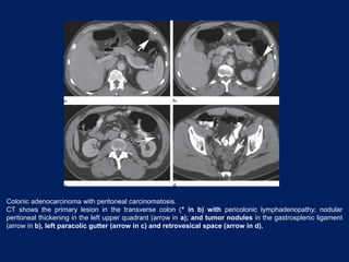 Colonic adenocarcinoma with peritoneal carcinomatosis.
CT shows the primary lesion in the transverse colon (* in b) with pericolonic lymphadenopathy; nodular
peritoneal thickening in the left upper quadrant (arrow in a); and tumor nodules in the gastrosplenic ligament
(arrow in b), left paracolic gutter (arrow in c) and retrovesical space (arrow in d).
 