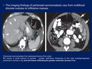 Peritoneal carcinomatosis from adenocarcinoma of the colon.
CT shows a small amount of ascites, nodular soft-tissue thickening of the right subdiaphragmatic
peritoneum (arrows in a), and soft tissue infiltrating the greater omentum (arrows in b).
• The imaging findings of peritoneal carcinomatosis vary from multifocal
discrete nodules to infiltrative masses.
 