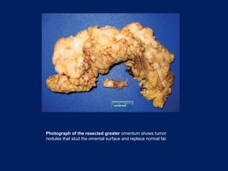 Photograph of the resected greater omentum shows tumor
nodules that stud the omental surface and replace normal fat.
 