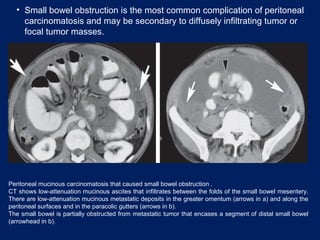 • Small bowel obstruction is the most common complication of peritoneal
carcinomatosis and may be secondary to diffusely infiltrating tumor or
focal tumor masses.
Peritoneal mucinous carcinomatosis that caused small bowel obstruction .
CT shows low-attenuation mucinous ascites that infiltrates between the folds of the small bowel mesentery.
There are low-attenuation mucinous metastatic deposits in the greater omentum (arrows in a) and along the
peritoneal surfaces and in the paracolic gutters (arrows in b).
The small bowel is partially obstructed from metastatic tumor that encases a segment of distal small bowel
(arrowhead in b).
 