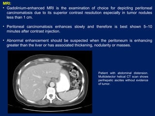 MRI:
• Gadolinium-enhanced MRI is the examination of choice for depicting peritoneal
carcinomatosis due to its superior contrast resolution especially in tumor nodules
less than 1 cm.
• Peritoneal carcinomatosis enhances slowly and therefore is best shown 5–10
minutes after contrast injection.
• Abnormal enhancement should be suspected when the peritoneum is enhancing
greater than the liver or has associated thickening, nodularity or masses.
Patient with abdominal distension.
Multidetector helical CT scan shows
perihepatic ascites without evidence
of tumor.
 