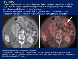 FDG PET/CT:
•The reported sensitivities for the detection of peritoneal carcinomatosis are 78%–
100%, with the highest sensitivities in patients with clinically suspected recurrent
tumor because of elevation in tumor markers.
•Metastatic foci appear as round, oval or globular areas of increased activity.
•Subcentimeter lesions may not demonstrate sufficient uptake to be visible.
Peritoneal carcinomatosis from ovarian carcinoma .
CT scan shows loculated ascites. (b) Fused PET/CT image shows focal, intense uptake in the left mid
abdomen (arrow) from a peritoneal metastatic deposit that is nearly isoattenuating relative to the ascites and
difficult to visualize with CT alone.
 