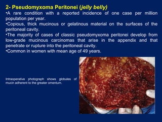 2- Pseudomyxoma Peritonei (jelly belly)
•A rare condition with a reported incidence of one case per million
population per year.
•Copious, thick mucinous or gelatinous material on the surfaces of the
peritoneal cavity.
•The majority of cases of classic pseudomyxoma peritonei develop from
low-grade mucinous carcinomas that arise in the appendix and that
penetrate or rupture into the peritoneal cavity.
•Common in women with mean age of 49 years.
Intraoperative photograph shows globules of
mucin adherent to the greater omentum.
 