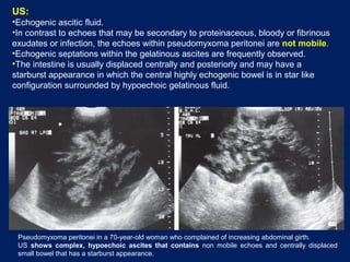 US:
•Echogenic ascitic fluid.
•In contrast to echoes that may be secondary to proteinaceous, bloody or fibrinous
exudates or infection, the echoes within pseudomyxoma peritonei are not mobile.
•Echogenic septations within the gelatinous ascites are frequently observed.
•The intestine is usually displaced centrally and posteriorly and may have a
starburst appearance in which the central highly echogenic bowel is in star like
configuration surrounded by hypoechoic gelatinous fluid.
Pseudomyxoma peritonei in a 70-year-old woman who complained of increasing abdominal girth.
US shows complex, hypoechoic ascites that contains non mobile echoes and centrally displaced
small bowel that has a starburst appearance.
 