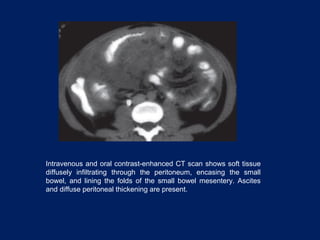 Intravenous and oral contrast-enhanced CT scan shows soft tissue
diffusely infiltrating through the peritoneum, encasing the small
bowel, and lining the folds of the small bowel mesentery. Ascites
and diffuse peritoneal thickening are present.
 