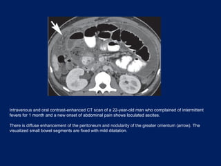 Intravenous and oral contrast-enhanced CT scan of a 22-year-old man who complained of intermittent
fevers for 1 month and a new onset of abdominal pain shows loculated ascites.
There is diffuse enhancement of the peritoneum and nodularity of the greater omentum (arrow). The
visualized small bowel segments are fixed with mild dilatation.
 
