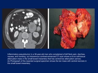 Inflammatory pseudotumor in a 36-year-old man who complained of left flank pain, diarrhea,
nausea, and vomiting. (a) Intravenous contrast-enhanced CT scan shows a 6-cm soft-tissue
attenuation mass in the small bowel mesentery that has central low attenuation (arrow).
(b) Photograph of the resected surgical specimen shows the tan mass with central necrosis in
the small bowel mesentery.
 