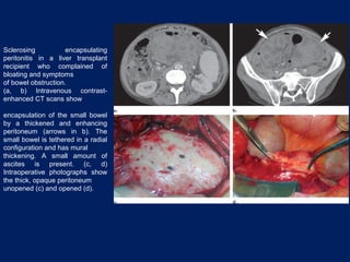 Sclerosing encapsulating
peritonitis in a liver transplant
recipient who complained of
bloating and symptoms
of bowel obstruction.
(a, b) Intravenous contrast-
enhanced CT scans show
encapsulation of the small bowel
by a thickened and enhancing
peritoneum (arrows in b). The
small bowel is tethered in a radial
configuration and has mural
thickening. A small amount of
ascites is present. (c, d)
Intraoperative photographs show
the thick, opaque peritoneum
unopened (c) and opened (d).
 