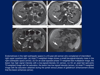 Endometriosis in the right subhepatic space in a 43-year-old woman who complained of intermittent
right upper quadrant pain. (a) Axial T1-weighted image shows a small low-signal-intensity mass in the
right subhepatic space (arrow). (b) On an axial opposed phase T1-weighted fast multiplanar image, the
lesion has high signal intensity with a low-signal-intensity rim (arrow). (c) On an axial fast spin-echo
T2-weighted image with fat saturation, the lesion has low signal intensity (arrow). (d) Axial T1-weighted
image with fat saturation obtained during the portal venous phase of gadolinium enhancement shows
that the lesion enhances (arrow).
 