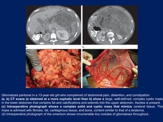 Gliomatosis peritonei in a 13-year-old girl who complained of abdominal pain, distention, and constipation.
(a, b) CT scans (a obtained at a more cephalic level than b) show a large, well-defined, complex cystic mass
in the lower abdomen that contains fat and calcifications and extends into the upper abdomen. Ascites is present.
(c) Intraoperative photograph shows a complex solid and cystic mass that mimics cerebral tissue. The
mass is admixed with fibrosis, fat, cartilaginous tissue, and bone, content similar to that of a teratoma.
(d) Intraoperative photograph of the omentum shows innumerable tiny nodules of gliomatosis throughout.
 