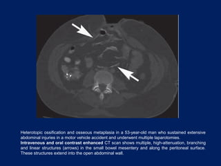Heterotopic ossification and osseous metaplasia in a 53-year-old man who sustained extensive
abdominal injuries in a motor vehicle accident and underwent multiple laparotomies.
Intravenous and oral contrast enhanced CT scan shows multiple, high-attenuation, branching
and linear structures (arrows) in the small bowel mesentery and along the peritoneal surface.
These structures extend into the open abdominal wall.
 
