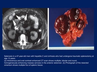 Splenosis in a 47-year-old man with hepatitis C and cirrhosis who had undergone traumatic splenectomy at
age 13 years.
(a) Intravenous and oral contrast enhanced CT scan shows multiple, lobular and round,
homogeneously enhancing masses (arrows) in the anterior abdomen. (b) Photograph of the resected
omentum shows multiple foci of splenic tissue.
 