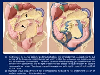 (a) Illustration of the normal posterior peritoneal reflections and intraabdominal spaces shows the cut
surface of the transverse mesocolon (arrow), which divides the peritoneum into supramesocolic
and inframesocolic compartments. The root of the small bowel mesentery (arrowhead) divides the
inframesocolic compartment into the right and left infracolic spaces. The cut surface of the sigmoid
mesentery is also shown. The sigmoid mesentery serves as a watershed to channel peritoneal fluid
into the pelvis.
(b) Illustration shows the pathways of flow of intraperitoneal fluid and the four predominant sites (*) of
stasis of ascitic fluid in the lower abdomen.
 