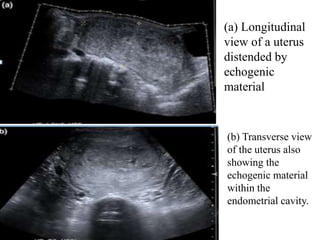 (a) Longitudinal
view of a uterus
distended by
echogenic
material
(b) Transverse view
of the uterus also
showing the
echogenic material
within the
endometrial cavity.
 