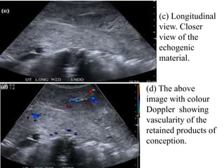 (c) Longitudinal
view. Closer
view of the
echogenic
material.
(d) The above
image with colour
Doppler showing
vascularity of the
retained products of
conception.
 