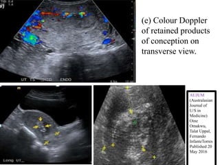 (e) Colour Doppler
of retained products
of conception on
transverse view.
AUJUM
(Australasian
Journal of
U/S in
Medicine)
Oine
Omakwu,
Talat Uppal,
Fernando
InfanteTorres
Published 20
May 2016
 